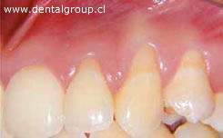 Reseci&oacute;n Gingival caso 1