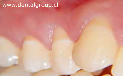 Reseci&oacute;n Gingival caso 2